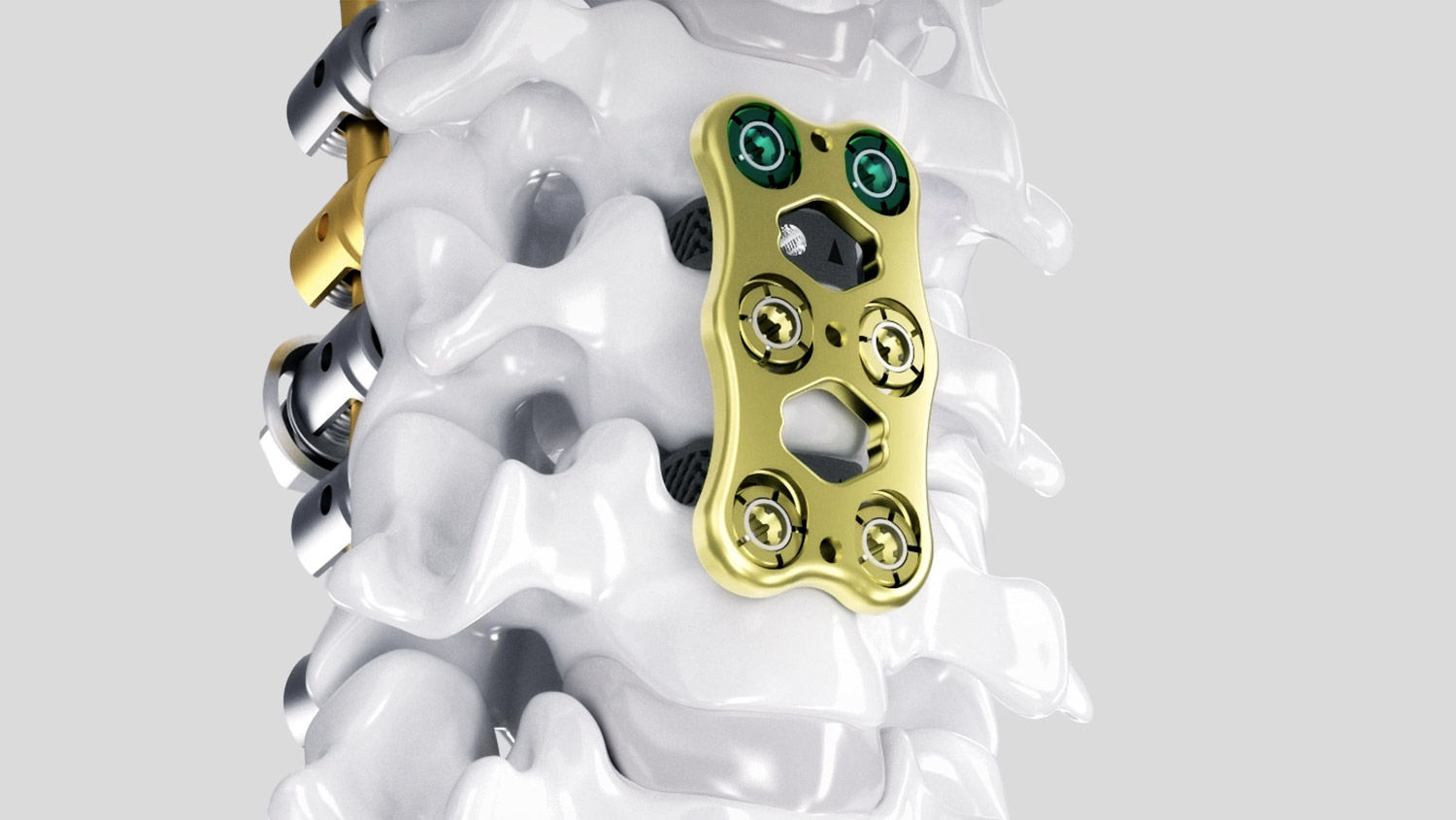 Ennovate® Cervical s AESCULAP® CeSPACE® 3D a Quintex®