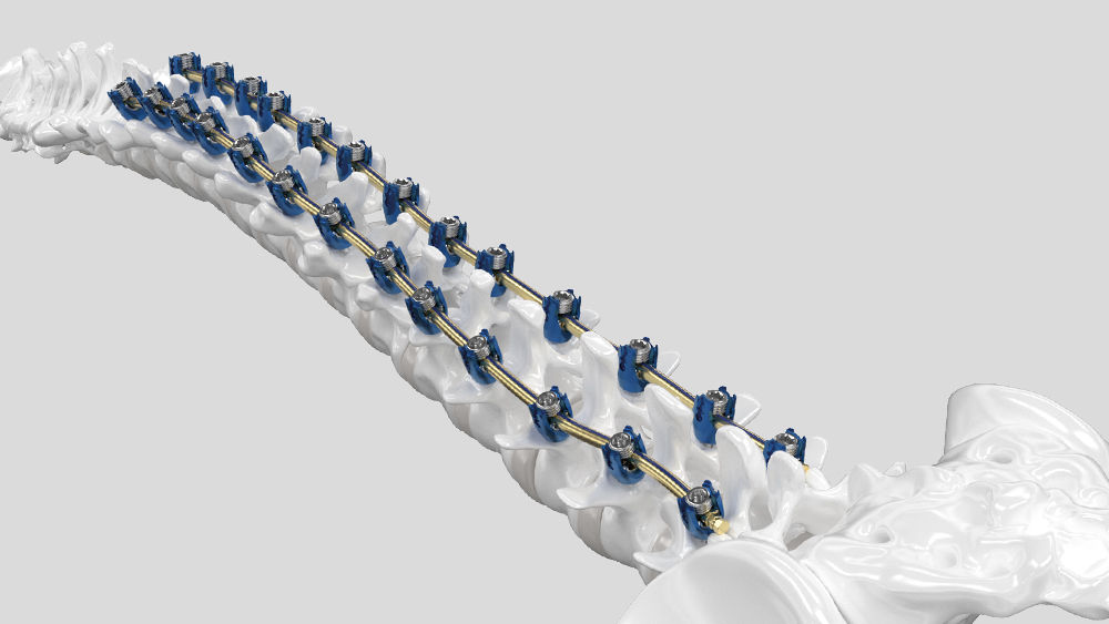 Chirurgický modul Ennovate® Thoracolumbar & Sacropelvic