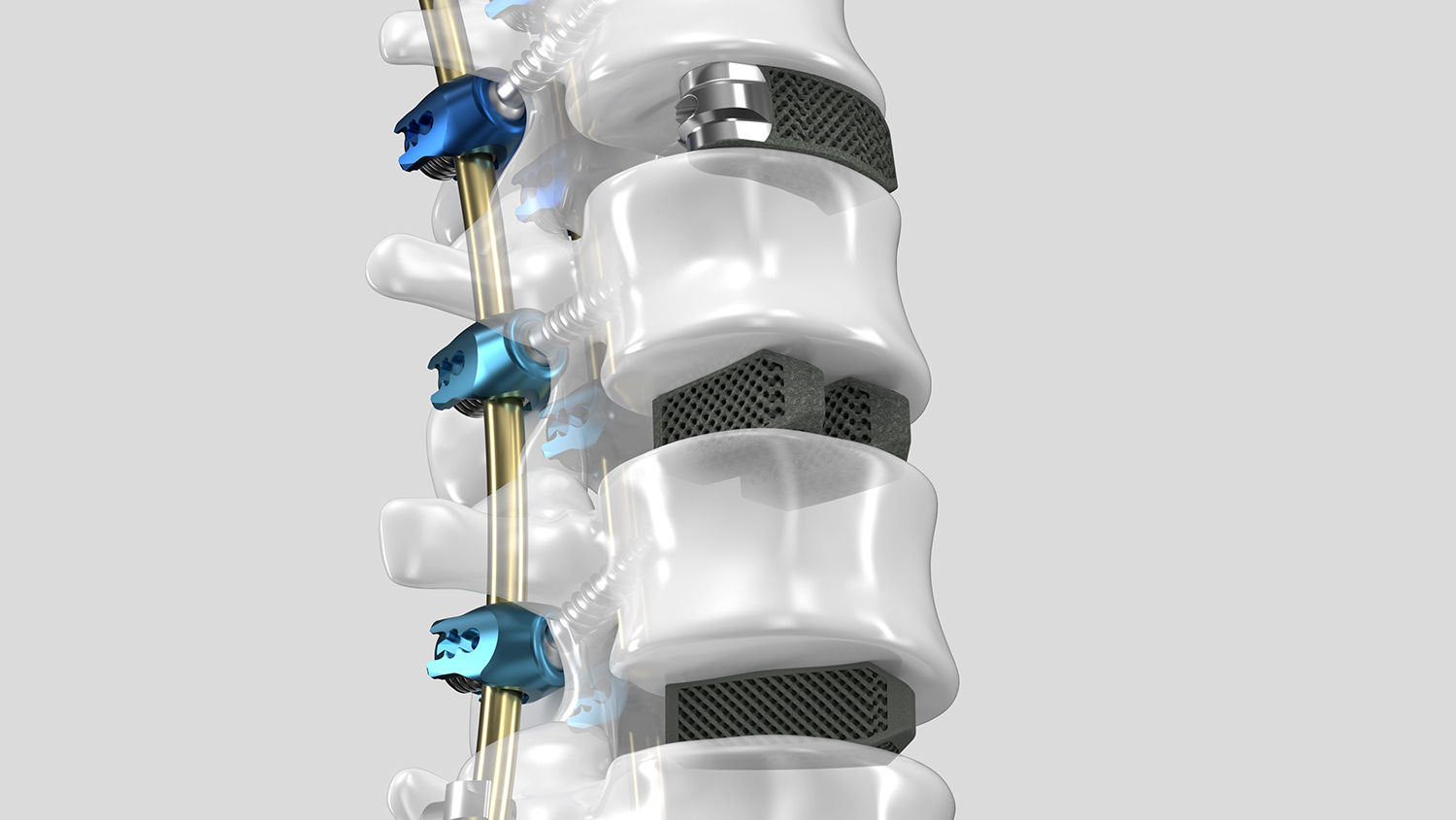Ennovate® Thoracolumbar & Sacropelvic s pomôckami na 3D medzistavcovú fúziu AESCULAP®